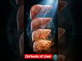 Cirrhosis of Liver #shorts #trending #medicalshorts #liver #facts #neet #new#bams #ayurveda