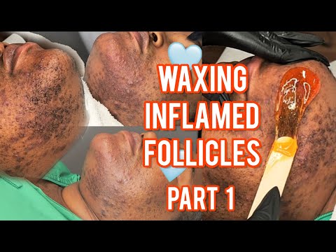 Waxing Inflamed Follicles Part 1 | NEW Client Alert! This Is #Hirsutism