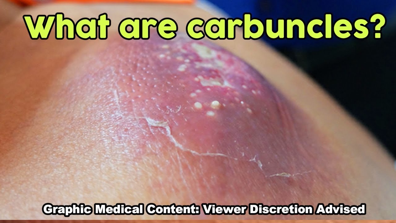 Carbuncle, Carbuncles, MORE Carbuncles - YouTube