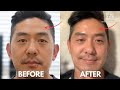Forehead Wrinkle Removal | Seoul Guide Medical