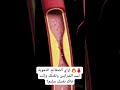 إزاي الصفائح الدموية تسد الشرايين وتقتلك وإنت فاكر نفسك سليم 