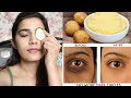 *Most Requested* How I Removed My dark Circles ACTUALLY  | Super Style Tips