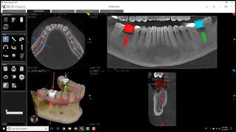 Carestream 3D Imaging - Cross Section Tool