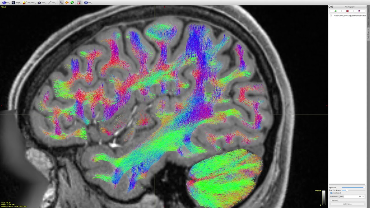 Multi-tissue constrained spherical deconvolution on HCP data #MedicalRadiology Multi-tissue constrained spherical deconvolution on HCP data #MedicalRadiology