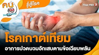 โรคเกาต์เทียม อาการปวดบวมอักเสบตามข้อเฉียบพลัน | รู้สู้โรค