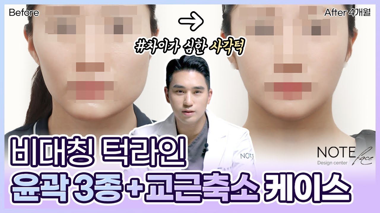 [유.케.리] 📍 CT로 보는 케이스 리뷰 l 턱 뼈 비대칭 l 돌아간 턱 끝 l 교근 축소l