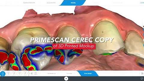 Digital Smile Design Aug 2020 - Single Visit Veneers with PRIMESCAN & PRIMEMILL
