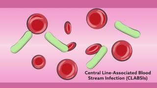 Central line catheters in children: common complications and infection prevention strategies