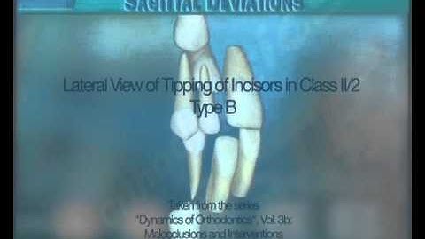 Clip 40: Lateral View of Tipping of Incisors in Class II/2 Type B