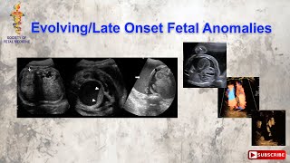 Evolving/Late Onset Fetal Anomalies