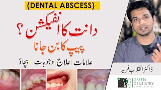 DENTAL ABSCESS | PUS in Teeth | GUM Swelling | دانتوں میں پیپ کا بننا | Urdu | @InqalabFareed