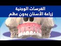 © الغرسات الوجنية - كيفية وضع زراعة الأسنان بدون عظم