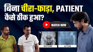 How MIS Bikini DAA Saved a Patient After Failed Screw Surgery | In Delhi NCR – Dr. DP Sharma