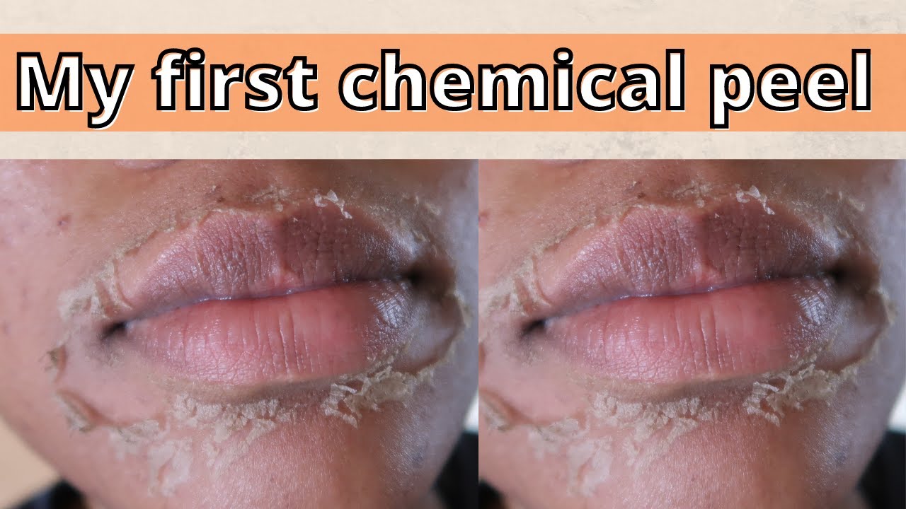 My skincare journey First Mandelic Acid peel. Mandelicpeel 