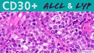 Anaplastic Large Cell Lymphoma & Lymphomatoid Papulosis: CD30 Positive Lymphoproliferative Disorders