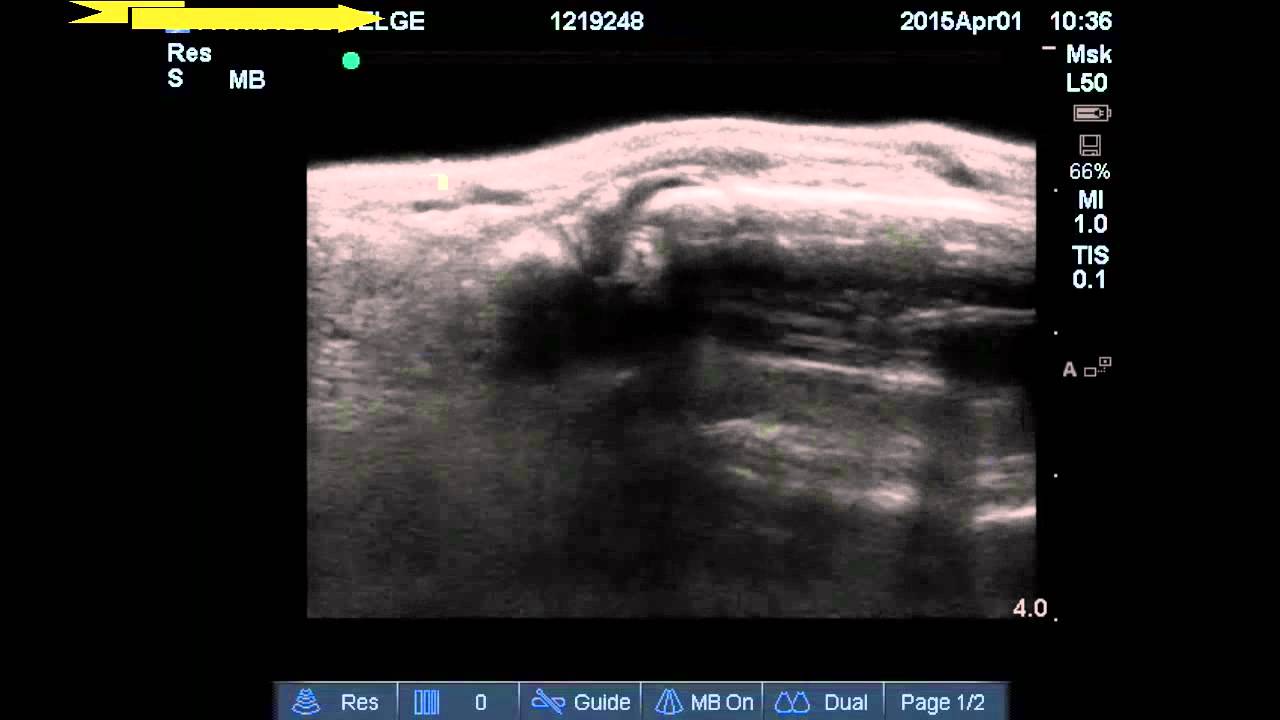 Ultrasound of the Finger Water bath scan YouTube