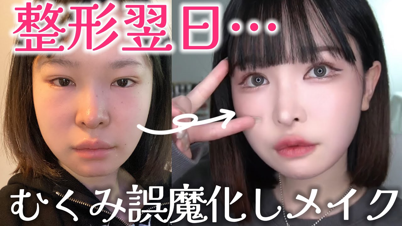 一番のコンプレックスを整形した翌日、むくみ最強ごまかしメイク🤕【脂肪吸引DT1日目】