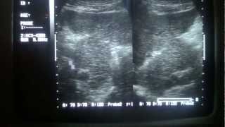Ultrasound Hyperplasia Of Caudate Lobe Of Liver