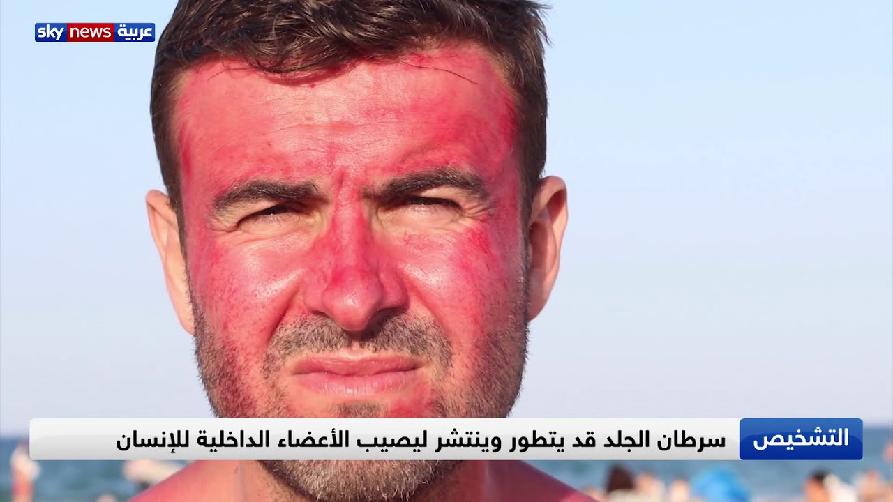 سرطان الجلد.. أنماط مختلفة والسبب الشمس