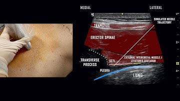 Paravertebral Block // Ultrasound-Guided Demonstration