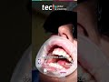 Disfunção da ATM em Cirurgia Ortognática e Estabilidade Oclusal | TECH Global University