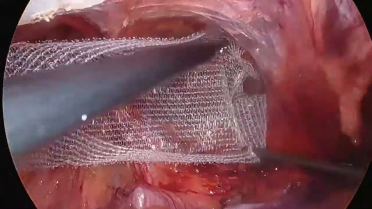 Key steps & anatomy : Laparoscopic inguinal hernia repair ( TAPP ) with self gripping mesh and glue