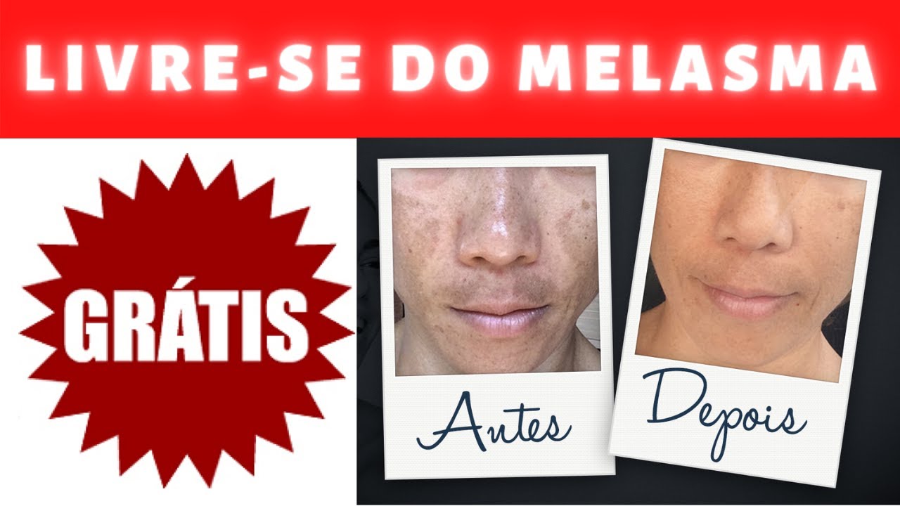 Beauty Clean - o fim das manchas do melasma e manchas outras escuras -Amostra grátis para 7 dias