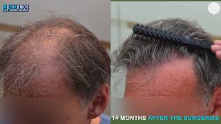 FUE Patchy 2931 Fu´s Dr Lupanzula MeDiKemos ENG #hairtransplant