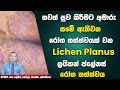         lichen planus     