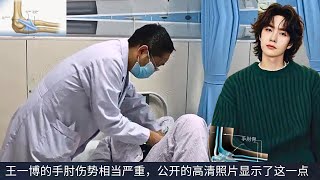 видео: Травма локтя Ван Ибо довольно серьезна, и общедоступные фотографии высокого разрешения это подтвержд картинка: Травма локтя Ван Ибо довольно серьезна, и общедоступные фотографии высокого разрешения это подтвержд