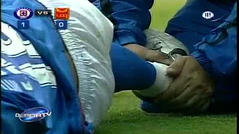 Worst Fracture Ever: Edgar Andrade