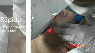 Edge One - Fractional Laser CO2 - Ανάπλαση, ουλές ακμής, ραγάδες