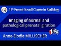 Imaging of normal and pathological prenatal giration - Anne-Elodie MILLISCHER