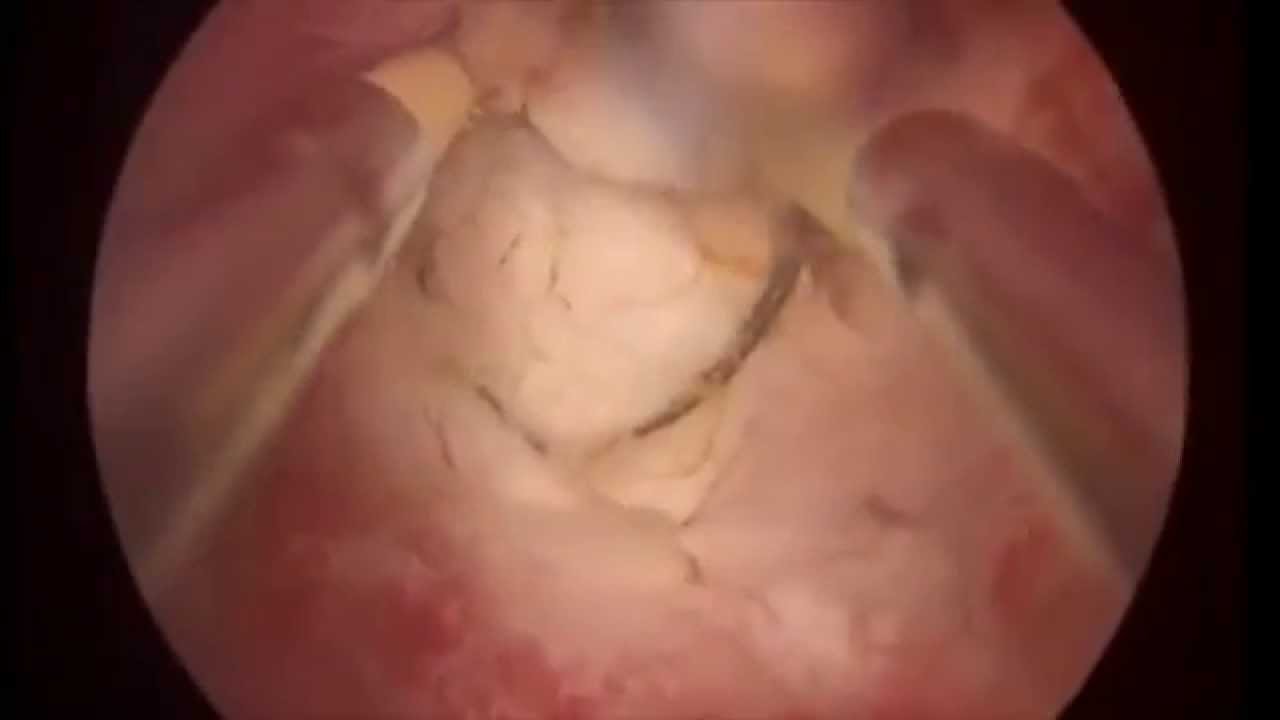 Гистероскопия, миомэктомия узла G 0 по задней стенке звук