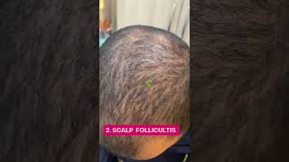 Skin Conditions on Rise Post Covid| Lichen Planus| Alopecia areata| LPP | scalp follicultis |Parisa
