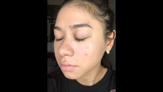 Tretinoin 3 Month Update (With Photo's)