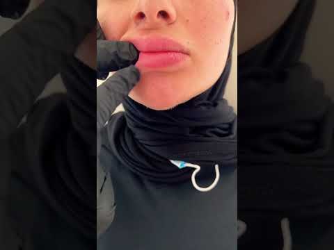 Video: Schmerzhafte, rissige Lippen loswerden (mit Bildern)