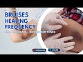 Bruises Rife Frequency Cure | Pure Tone Binaural Beats + Isochronic Tones Healing Sounds