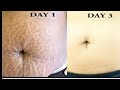 QUICK & EASY NATURAL TIPS TO REMOVE STRETCH MARKS