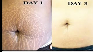 QUICK & EASY NATURAL TIPS TO REMOVE STRETCH MARKS