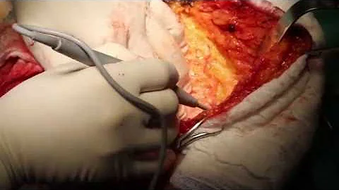 Como é feita a mastectomia simples?
