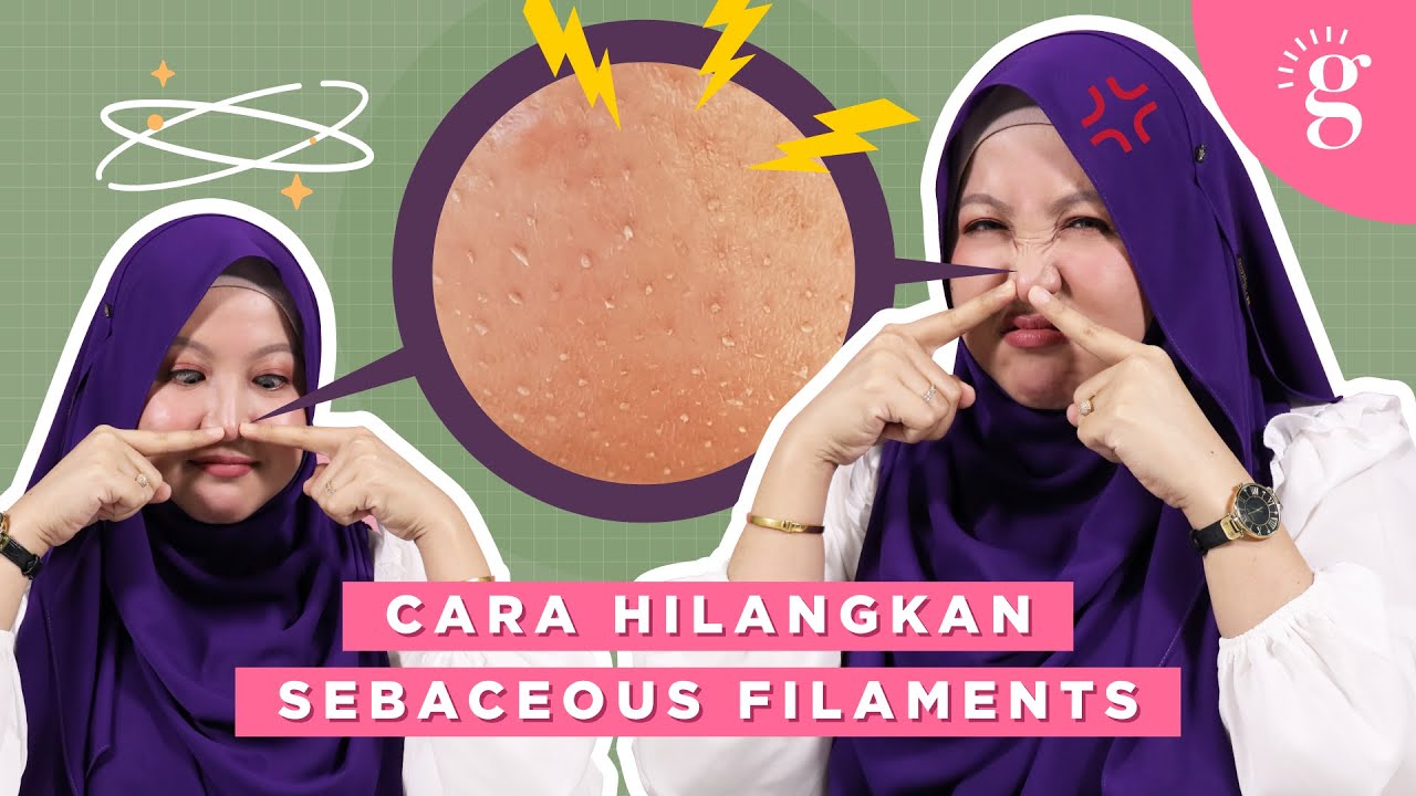 Punca Dan Cara Hilangkan Sebaceous Filament Youtube