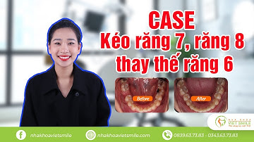 Review niềng răng ca kéo răng 7,8 thay thế răng 6 bị mất