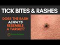 Two RASHES one TICK - How to Identify a Tick Rash