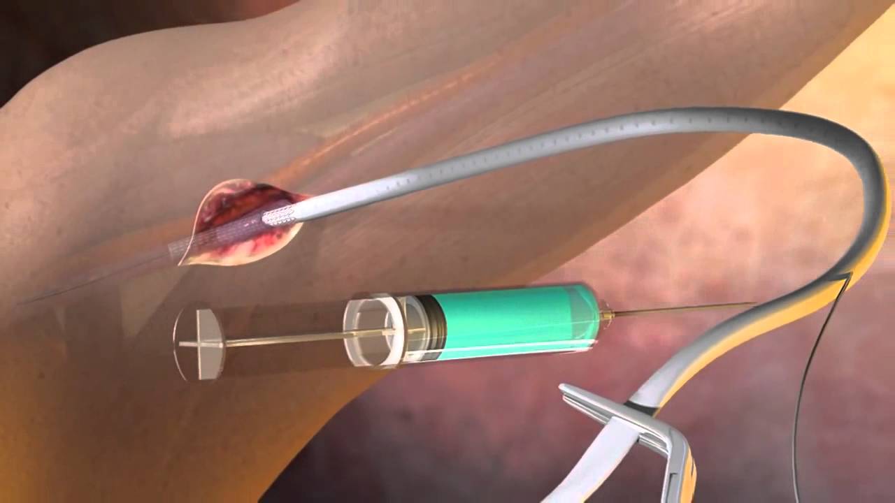 Prótese Vascular GORE® Hybrid - YouTube