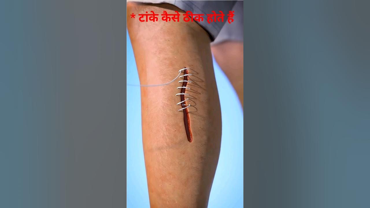 How Do Stitches Heal gk healthtips shorts how-do-stitches-heal-gk-healthtips-shorts