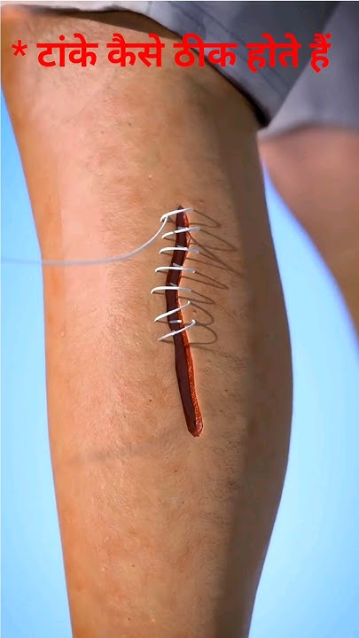 How Do Stitches Heal gk healthtips shorts how-do-stitches-heal-gk-healthtips-shorts
