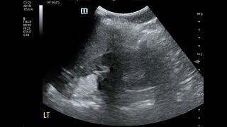 Acute Left Flank Pain in 17 y.o. Girl with Angiomyolipoma of Lt Kidney