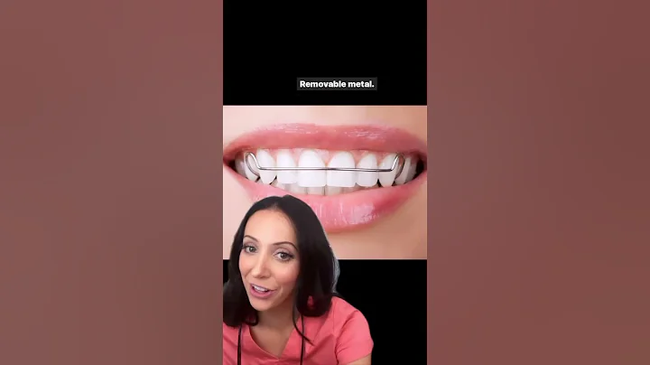 different types of retainers #shorts