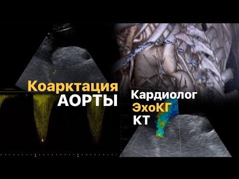 Коарктация аорты в 30+. Роды с коарктацией аорты. Кардиолог. ЭхоКГ -как не пропустить коарктацию. КТ